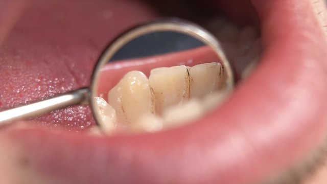 close-up of a dental mirror in the open mouth of a male patient at a dental clinic. Professional dentist examines a client's teeth before ultrasonic cleaning and treatment. tartar. plaque on the teeth