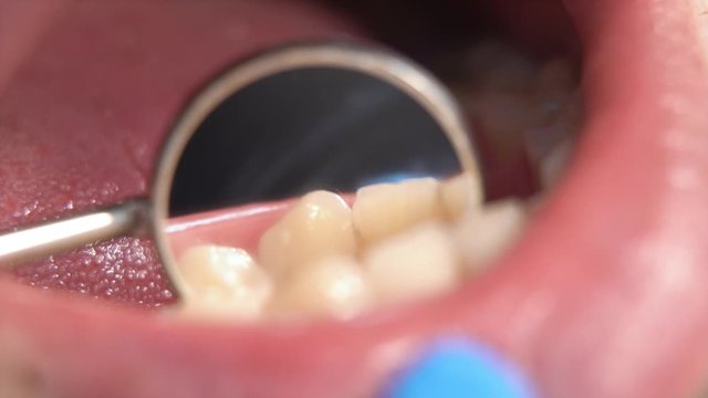 dentist examination. very close-up of teeth with tartar and plaque through a dentist's dental mirror during an examination in a stomatological clinic.