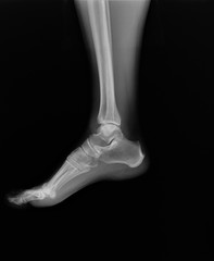 x- ray of the ankle joint in the lateral projection, arthritis, arthrosis