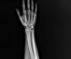 x-ray of the hand and wrist bones