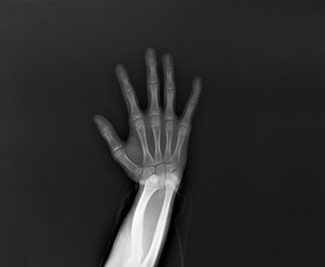 x-ray of the hand and wrist bones