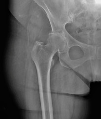 x- ray of the hip joint with coxarthrosis