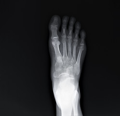 x-ray of the foot, diagnosis of fractures, arthritis, deforming arthrosis