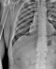 chest x-ray, diagnosis of coronavirus pneumonia