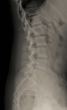 x- ray of the lumbar and sacral spine in a lateral projection