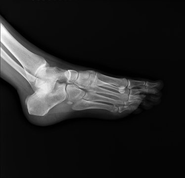 x-ray of the foot, diagnosis of fractures, arthritis, deforming arthrosis
