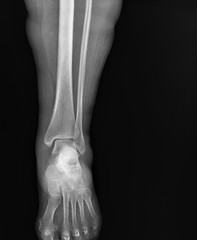 x- ray of the ankle joint in the frontal projection, arthritis, arthrosis