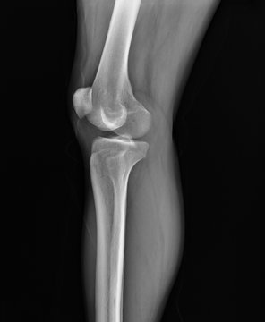 x-ray of the knee joint, diagnosis of arthrosis,arthritis
