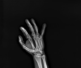 x-ray of the hand and wrist bones