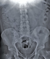 x- ray of the abdomen, spine and pelvis