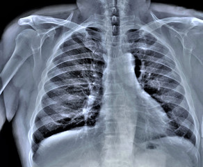 chest x-ray, diagnosis of coronavirus pneumonia