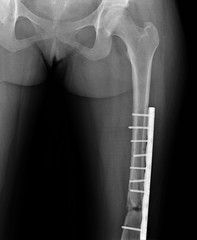 x- ray with a hip fracture fixed by a metal plate with screws