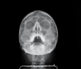 x- ray of the paranasal sinuses