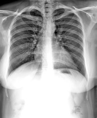 chest x-ray, diagnosis of coronavirus pneumonia