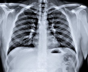 chest x-ray, diagnosis of coronavirus pneumonia