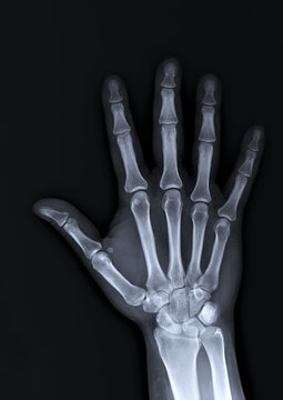 x-ray of the hand and wrist bones