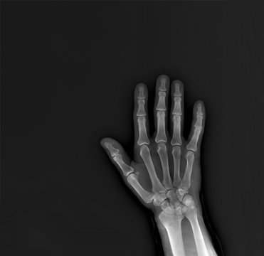 x-ray of the hand and wrist bones