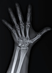 x-ray of the hand and wrist bones