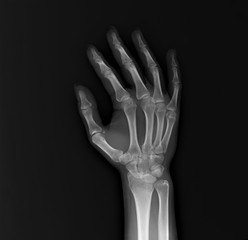 x-ray of the hand and wrist bones