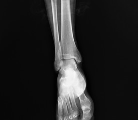 x- ray of the ankle joint in the frontal projection, arthritis, arthrosis