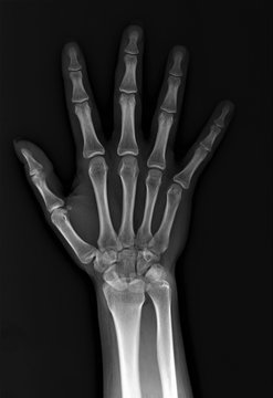 x-ray of the hand and wrist bones
