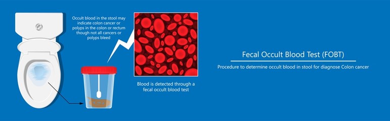 Fecal occult blood test FOBT lab stool sample bleeding screen risk examination collect container Guaiac diagnosis sign hemoccult smear FIT diagnostic