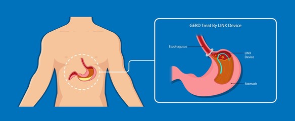 Gastroesophageal reflux disease (GERD) Hiatal Hernia treatment medication