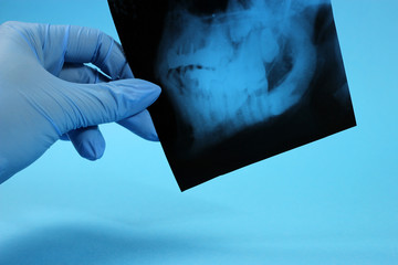 Dentistlooking teeth on x-ray, wisdom tooth