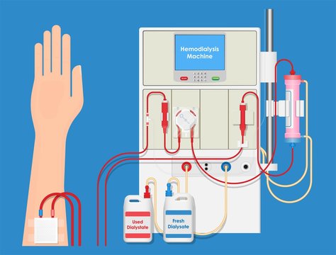Hemodialysis Machine Equipment Procedure Room Kidney Patient Treatment in Clinic Hospital Blood Filter Dialysis peritoneal hypercalcemia polycystic cysts