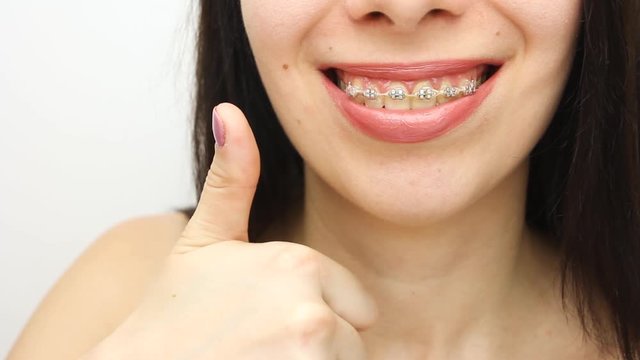 Dental braces in happy womans mouths who shows like. Brackets on the teeth after whitening. Self-ligating brackets with metal ties and gray elastics or rubber bands for perfect smile. Orthodontic teet