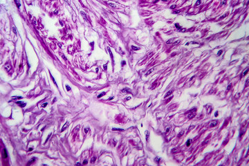 Uterine leiomyoma, light micrograph