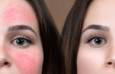 A young Caucasian girl shows the before and after results of intensive laser treatment to remove...