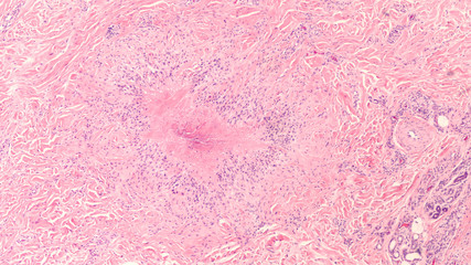 Photomicrograph of a rheumatoid nodule, a firm lump that may develop under the skin in...