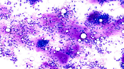 Fototapeta premium Fine needle aspiration (FNA) cytology of pleomorphic adenoma (