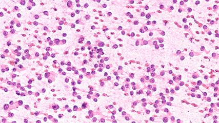 Squash prep cytology smear of a pituitary adenoma, a benign tumor of the pituitary, a hormone...