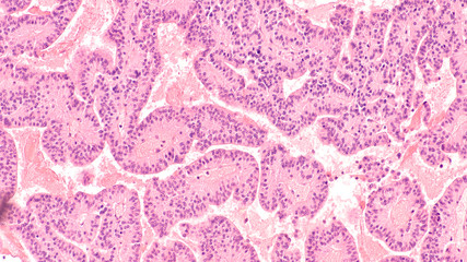 Microscopic image of a pituitary adenoma, a benign tumor of the pituitary, a hormone producing...