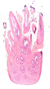 Microscopic image of a squamous papilloma, a benign lesion common in the mouth and throat, sometimes related to human papilloma virus (HPV),