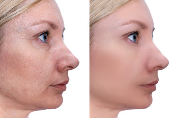 Woman face, before and after treatment - the result of rejuvenating cosmetological procedures of...