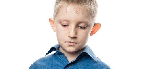 Child eye herpes disease on a face.