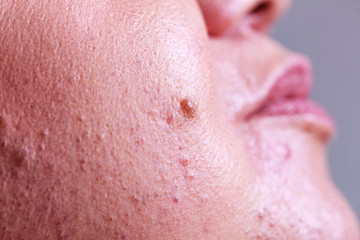Fototapeta premium Skin face after removing hair