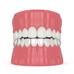 3d render of jaw with invisalign removable retainer