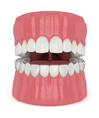 3d render of jaw with invisalign removable retainer