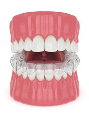 3d render of jaw with invisalign removable retainer