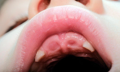 close-up of a baby's mouth without 2 upper milk teeth