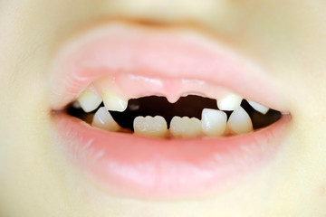 close-up of a baby's mouth without 2 upper milk teeth