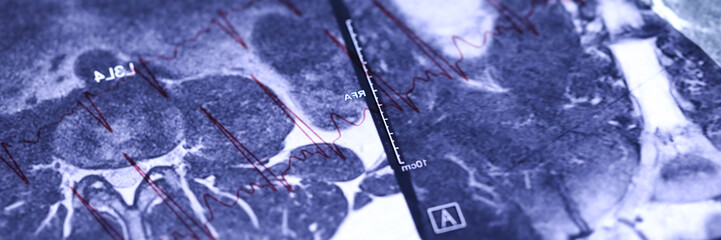MRI image lying over cardiogram chart