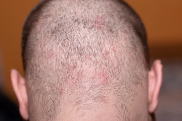 Back side of a man's head suffering from scalp acne - obrazy, fototapety, plakaty