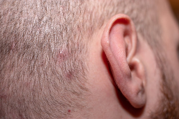Side view of a man's head with scalp acne