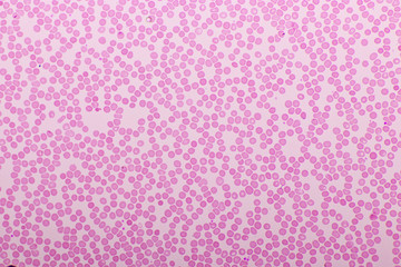 Red blood cells in blood smear, Wright-Giemsa stain, analyze by microscope, 400x