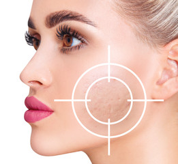 Aiming shows postacne and scarring on the skin of woman face.